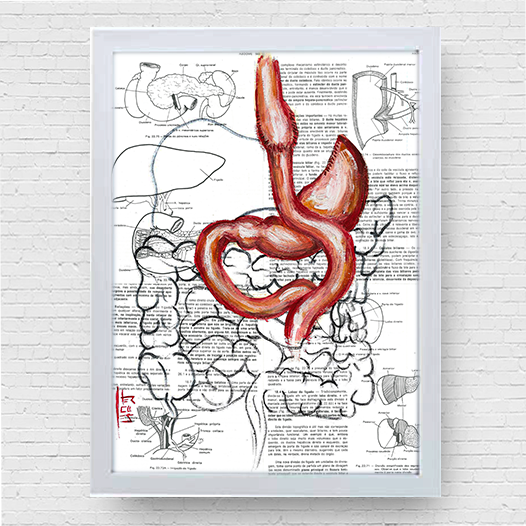 Quadro pôster anatomia: Estomago Bypass gástrico